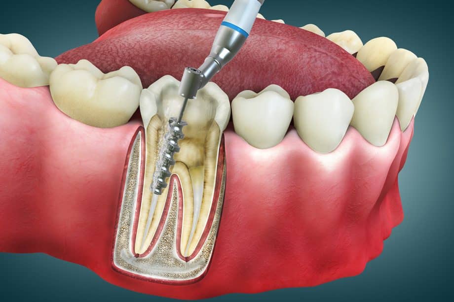 How Long Does It Take to Recover from a Root Canal?